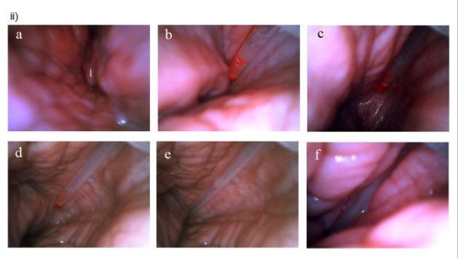 Post-cervical insemination seen from inside the uterus