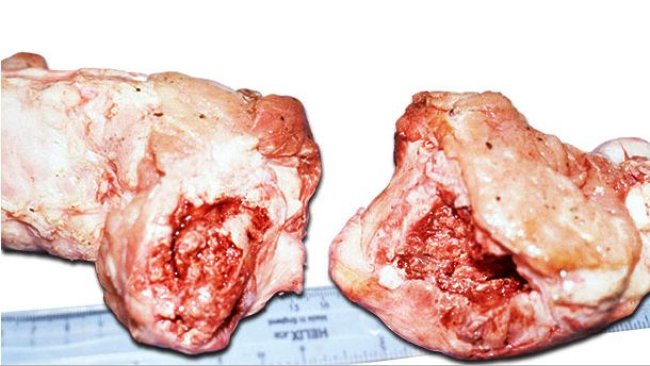 Entire head of the femur fractured at or below the epiphysis showing swelling around fracture site due to periostitis