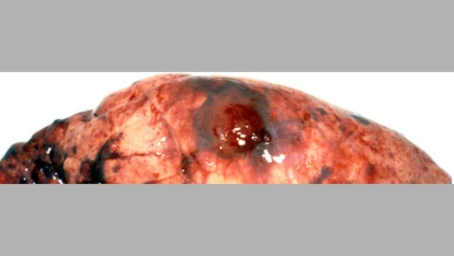 Chronic core lesion typical of Acpp – the haemorrhagic and necrotic lung lesion is overlain with pleural tags