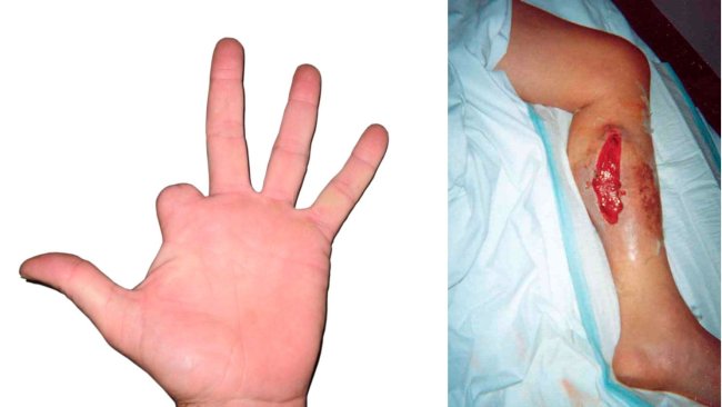 Picture 2: This producer accidently injected his finger with a vaccine containing an oil adjuvant. He did not seek immediate care for this, and the finger had to be amputated as the blood and nerve supply had been cut off by the inflammation.
Picture 3: Accidental vaccine injection. The leg had to be operated on to remove the damaged tissue, and flush out the vaccine and adjuvant.