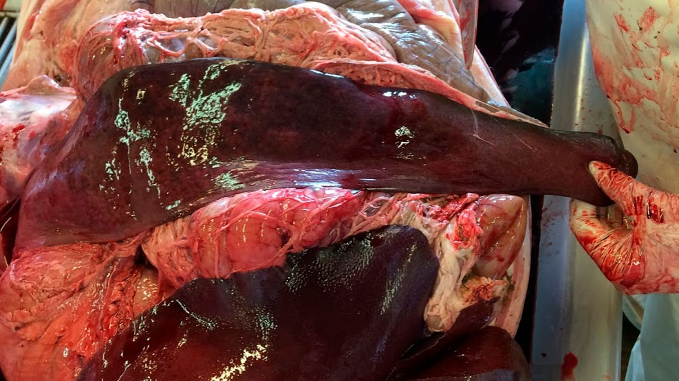 Splenomegaly