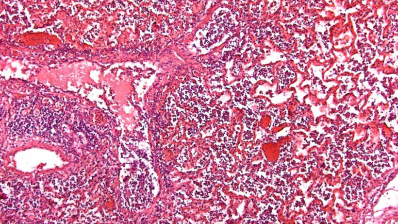 Fig 5: Alveoli full of fluid and inflammatory cell accumulation.
