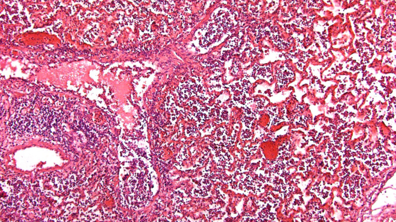 Fig 5: Alveoli full of fluid and inflammatory cell accumulation.
