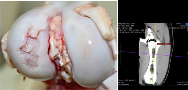 Macroscopic view of a knee joint with a severe osteochondrosis lesion in the lateral femoral condyle.
