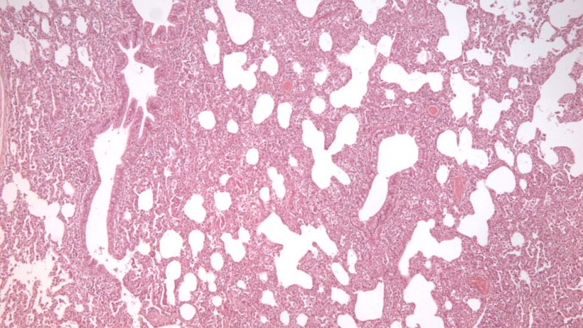 Figure2: Interstitial pneumonia, characterized by thickening of the alveolar walls, in a PRRSV infection.
