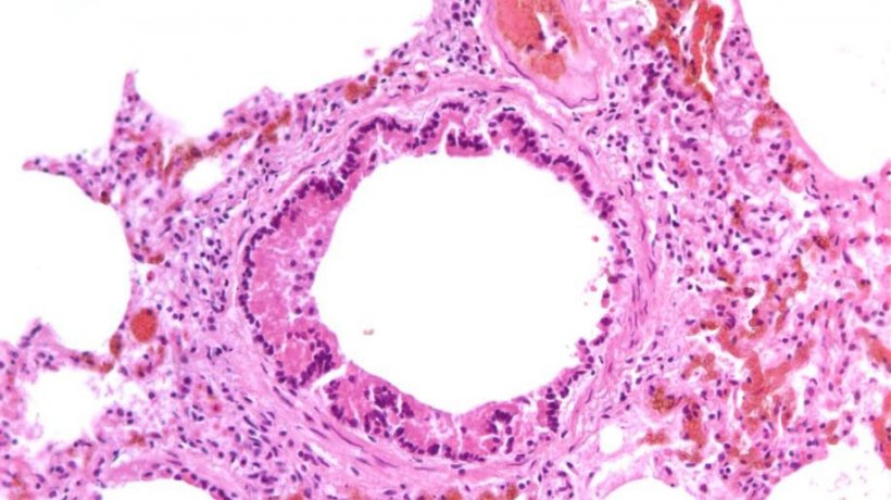 Figure&nbsp;5: Necrotizing bronchiolitis caused by SIV infection
