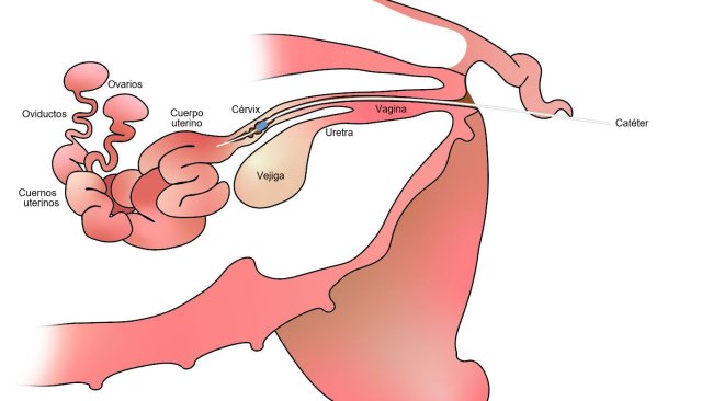 Figure 1. With post-cervical insemination the semen is deposited in the uterine body, past the cervix.