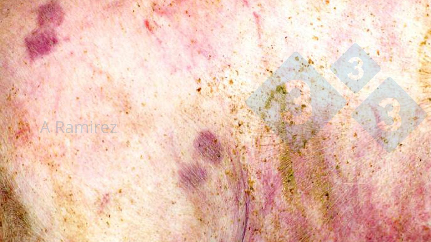 Figure 1.&nbsp;Almost pathognomonic diamond-shaped skin lesion.
