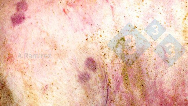 Figure 1. Almost pathognomonic diamond-shaped skin lesion.