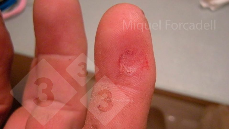 The small, sharp teeth of the piglets can cause these bothersome injuries to the workers' fingers during tooth grinding.
