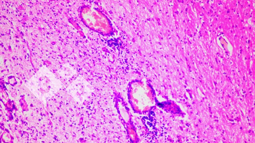 Figure 2. Perivascular cuffing and gliosis. Cerebrum.
