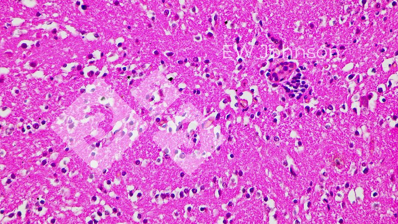 Figure 4.&nbsp;Cerebral encephalitis with vasculitis, satellitosis, and neuronophagia
