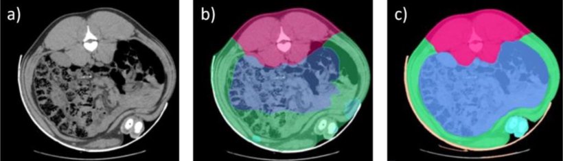 Figure 1. CT images, a) without segmentation, b) segmentation prior to AI implementation, c) with manual corrections of the segments used during the AI training process. The pink area corresponds to the spine, blue to the intestines, and green to the abdominal wall, with the limb segment appearing in turquoise.
