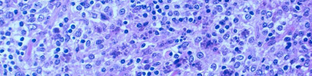 Severe lymphocyte depletion with granulomatous inflammation of lymphoid tissues. Presence of intracytoplasmic inclusion bodies