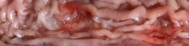 Thickening of the intestinal mucosa in the distal area of the small intestine