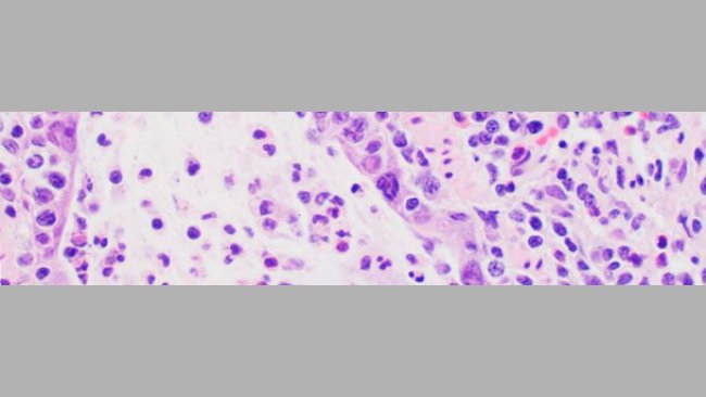Microscopic lesions consistent with influenza infection include necrosis of the bronchiolar epithelium where the virus replicates