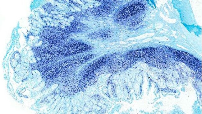 Ileum. The same ileum of the PCV2-systemi disease affected pig displays a massive amount of PCV2 genome at the Peyer’s patches and the intestinal mucosa. In situ hybridization to detect PCV2; fast green counterstain.